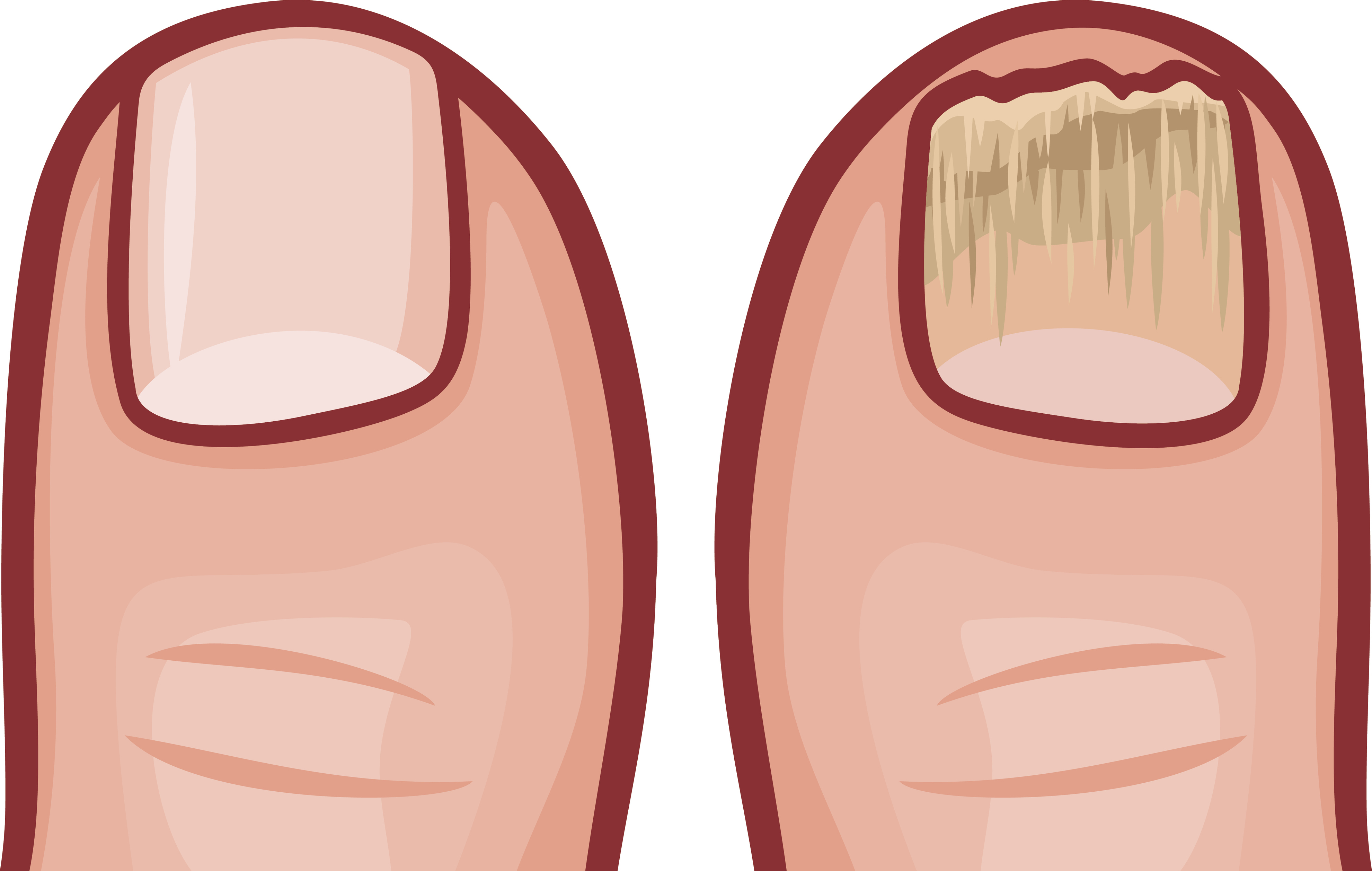 Illustration showing a fungal nail compared to a normal healthy nail (Thinkstock/PA)