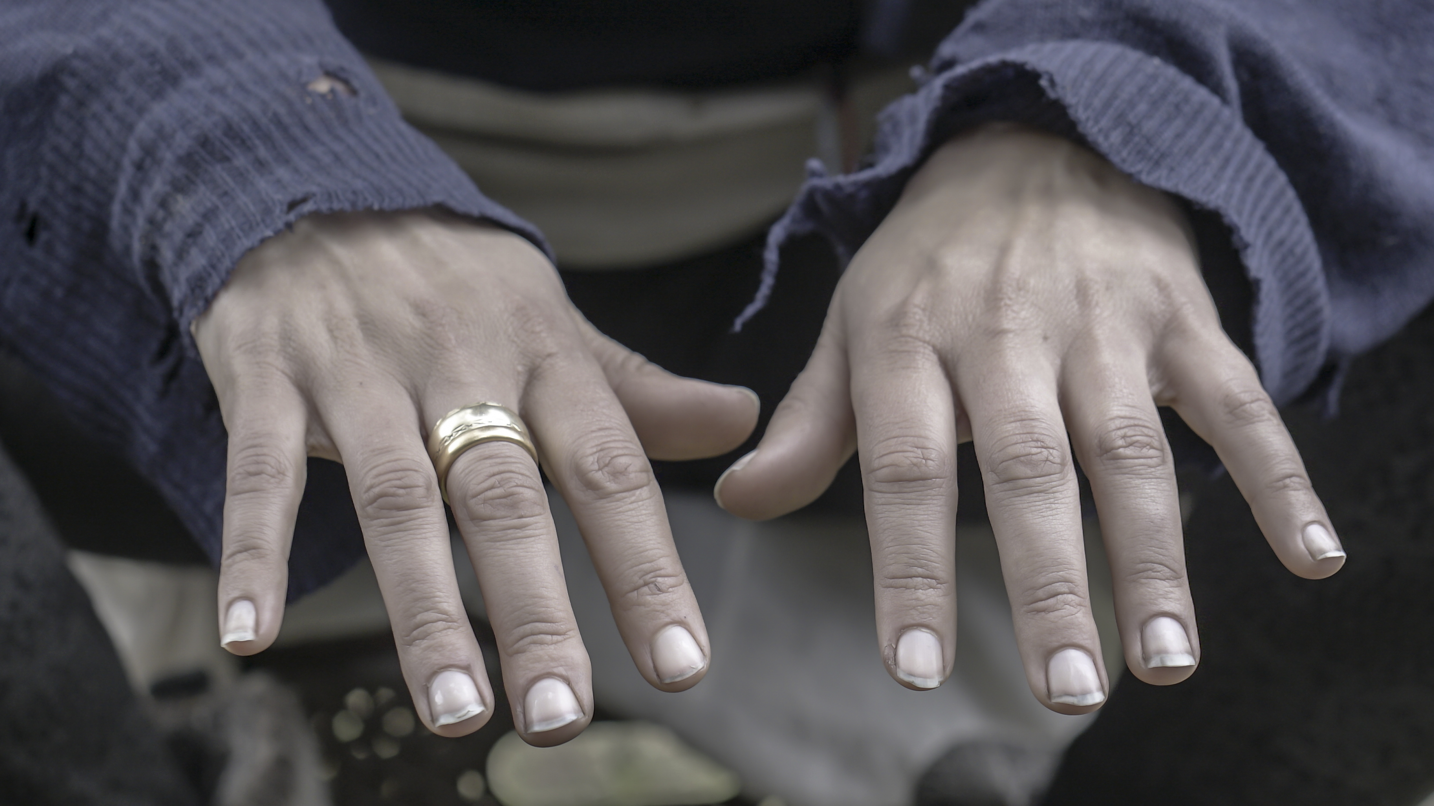Elise's hands after being exposed to the cold.