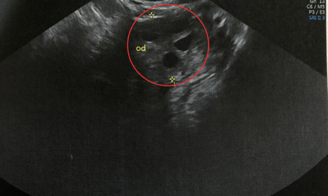 molar baby cancer