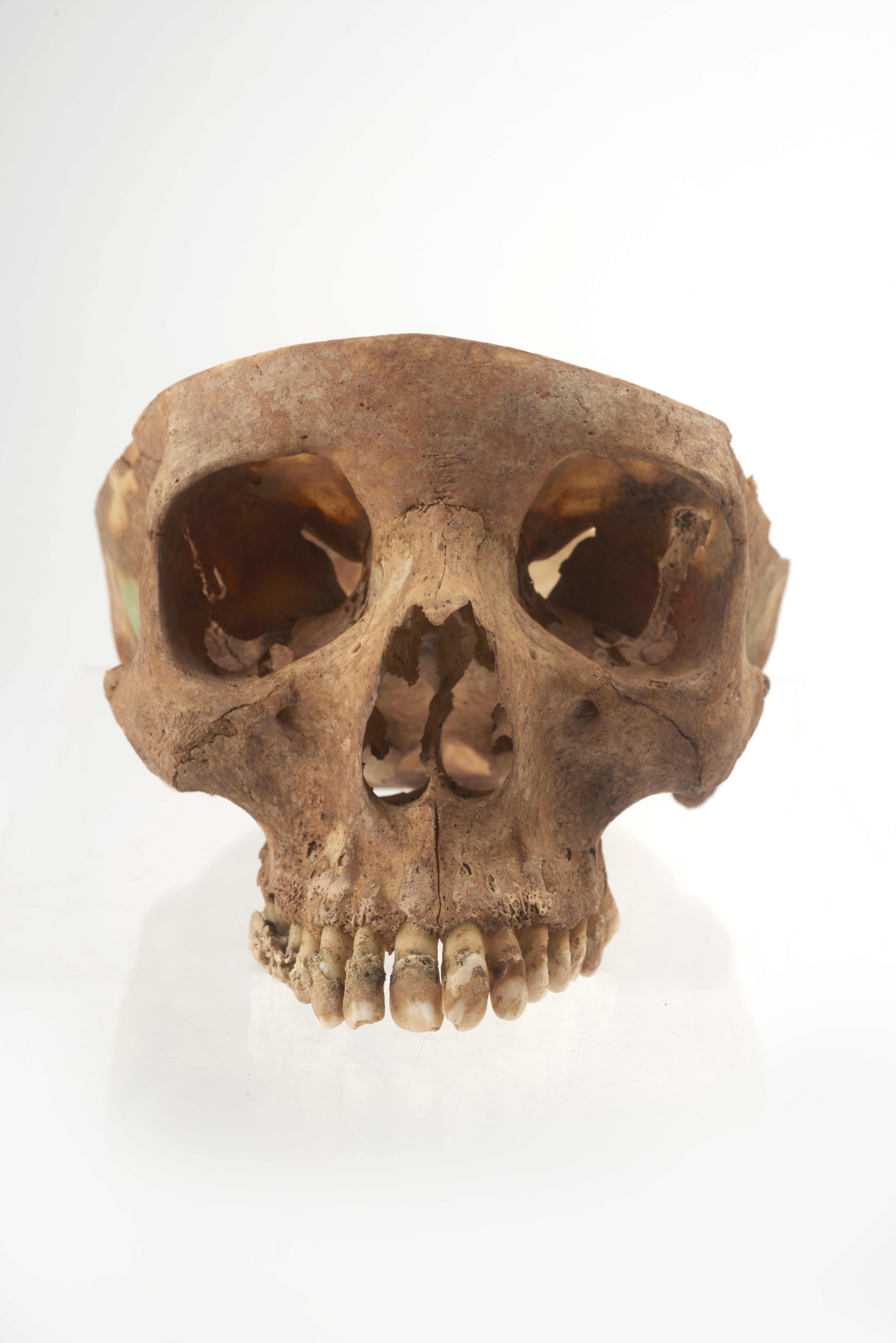 Woman's skull with severe dental plaque (Museum Of London)