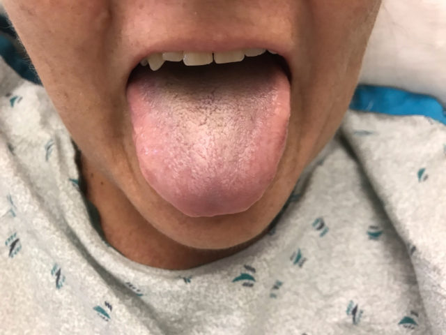 A Rare Case Of Black Hairy Tongue Has Been Treated In The Us The