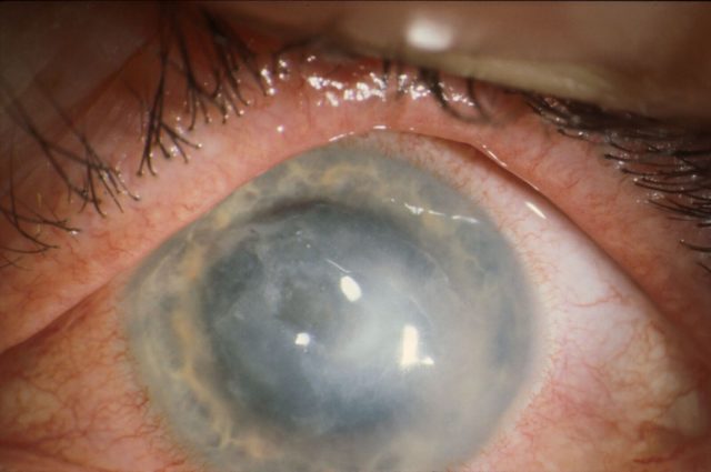 A severe case of the eye infection (Professor John Dart/ PA)