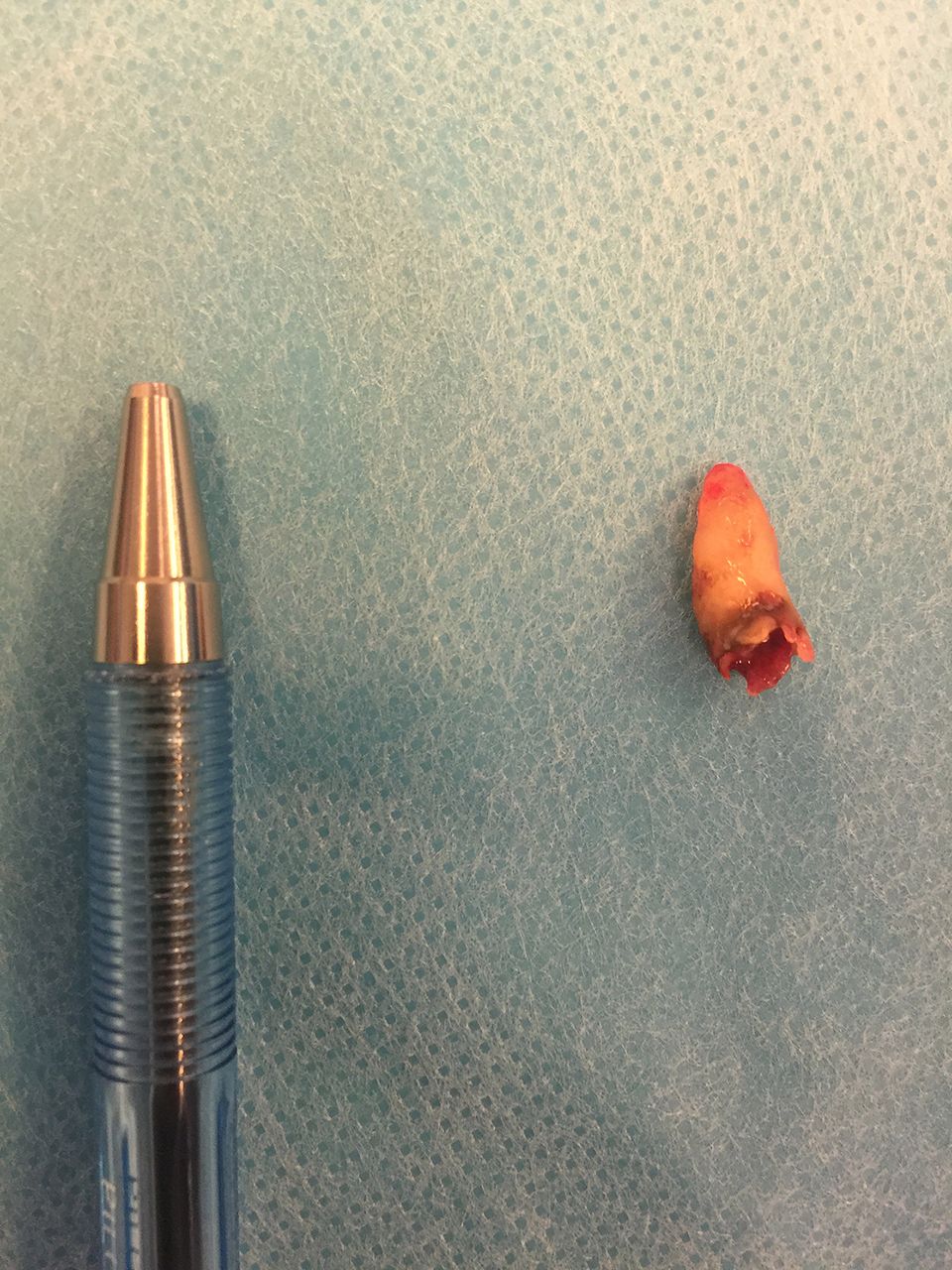 Dent removed from the nostril of the man