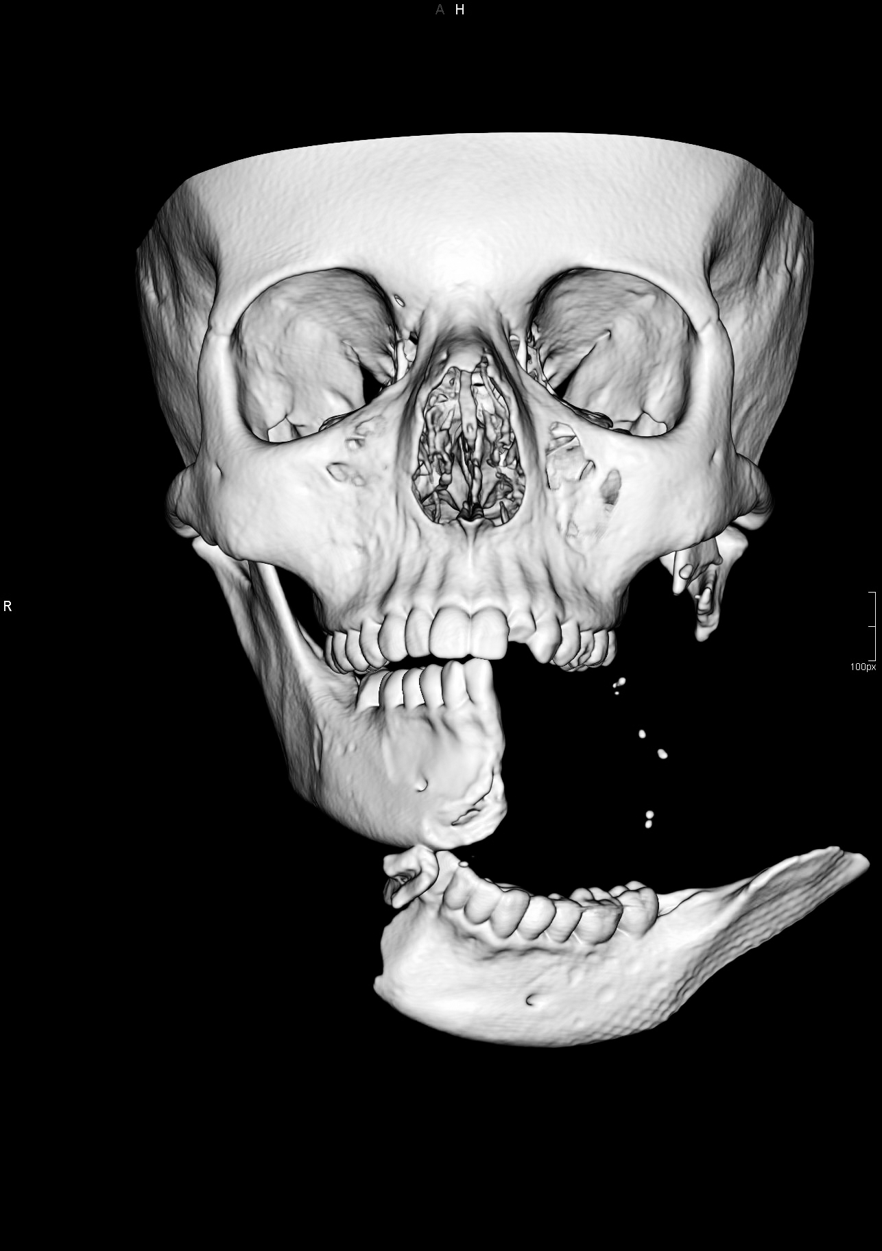 Pre-operation CT Scan 3D Image of injuries to Emily Eccles
