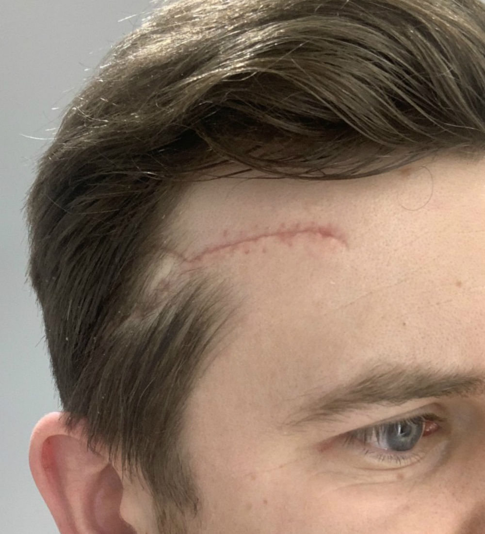 Head wound
