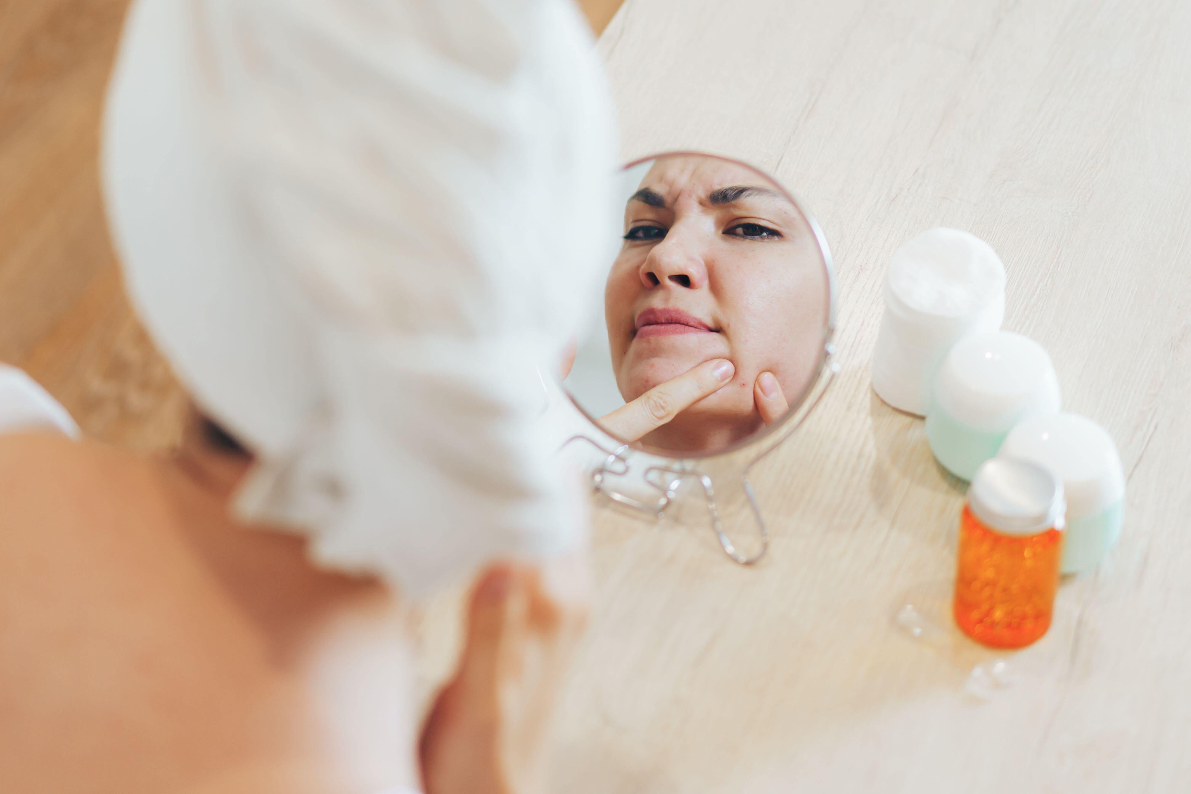Woman squeezing blackheads on her face in a mirror