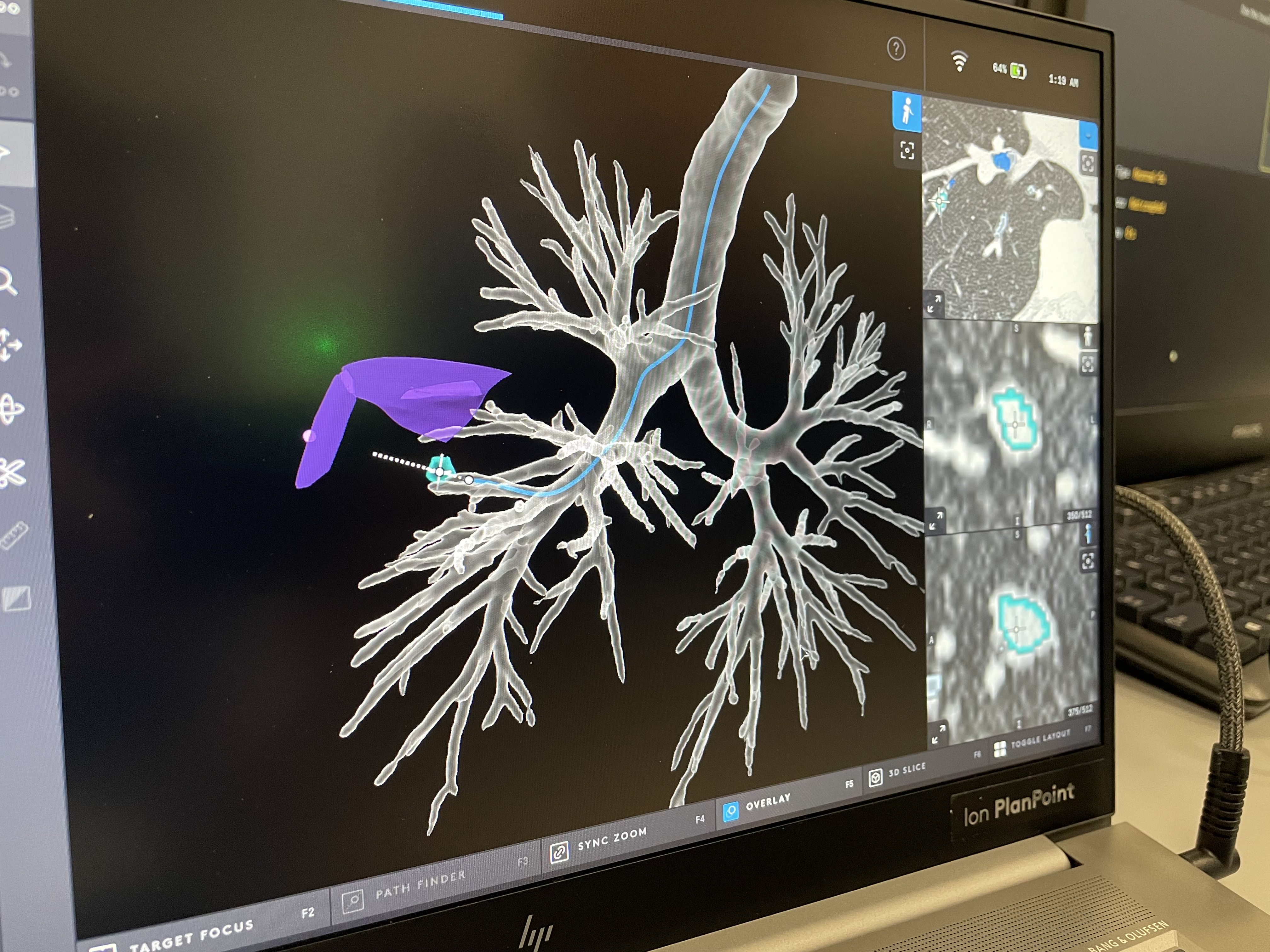 3D image of the lungs generated from CT scans. The suspected cancerous nodule is identified as the blue circle. The software generates a route for the catheter to be guided through the lungs.