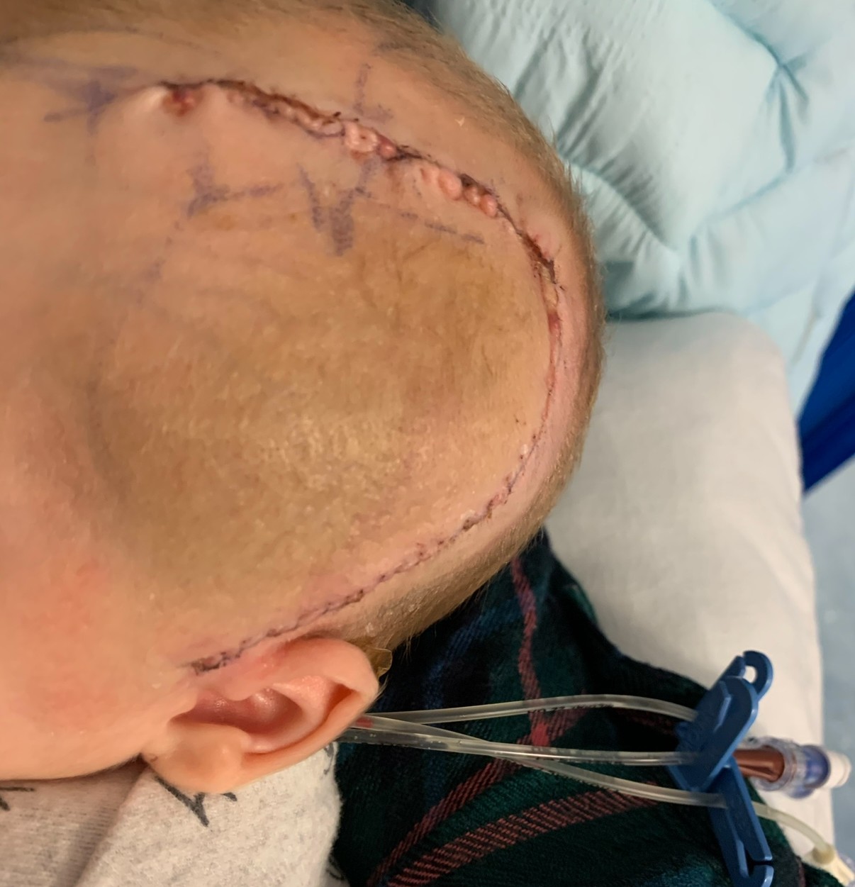 Joey's surgery scar