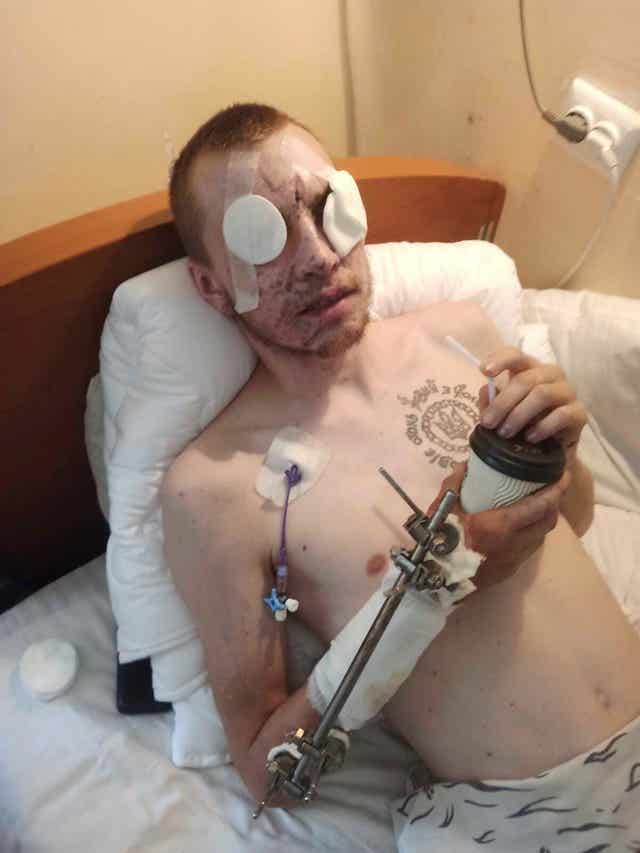 Blinded soldier