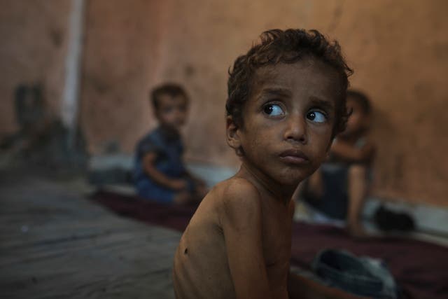 Yazan Abu Ful, a two-year-old malnourished child