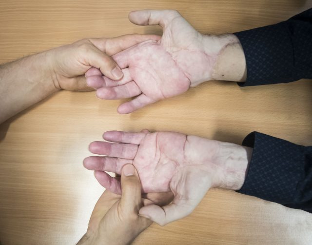 The hands of double hand transplant patient Chris King
