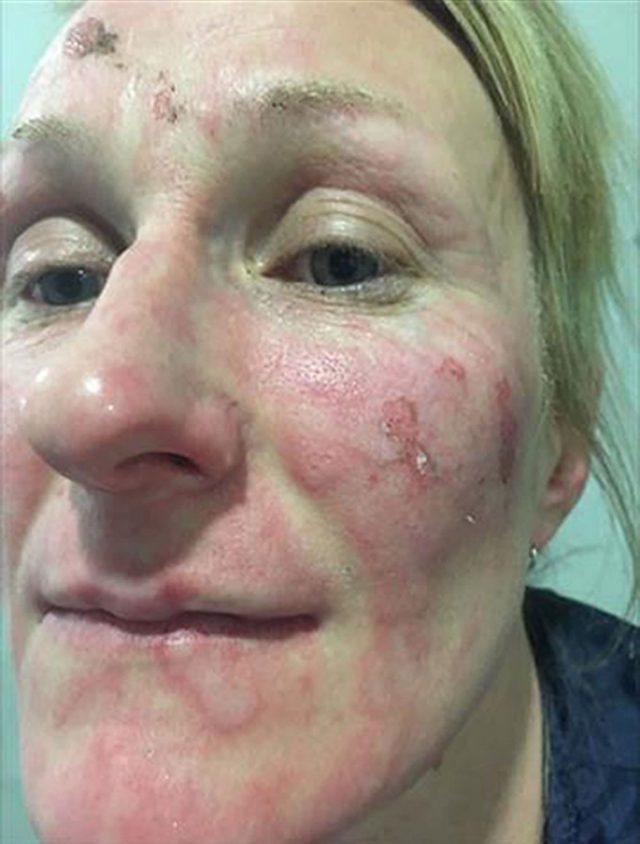 Erica Osbourne after she suffered burns to her face