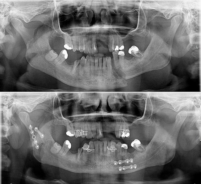 X-ray images of the trainspotter's jaw