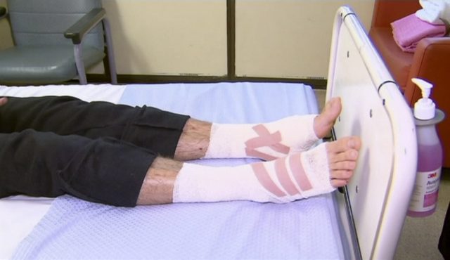 Sam Kanizay's bandaged legs