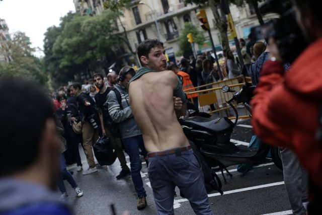 A man shows a bruise on his back allegedly caused by Spanish riot police