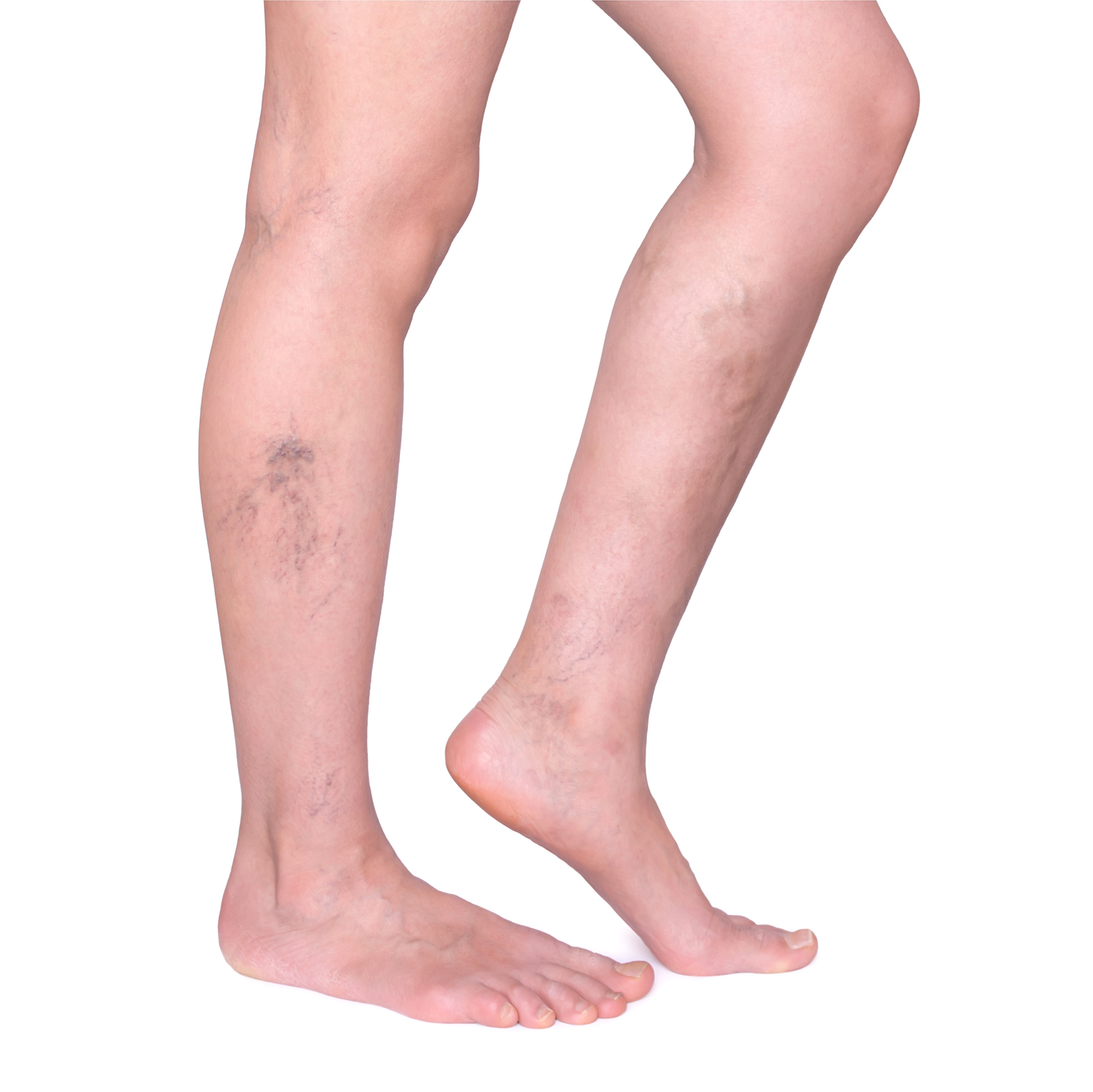 Generic photo of varicose veins in the legs (Thinkstock/PA)
