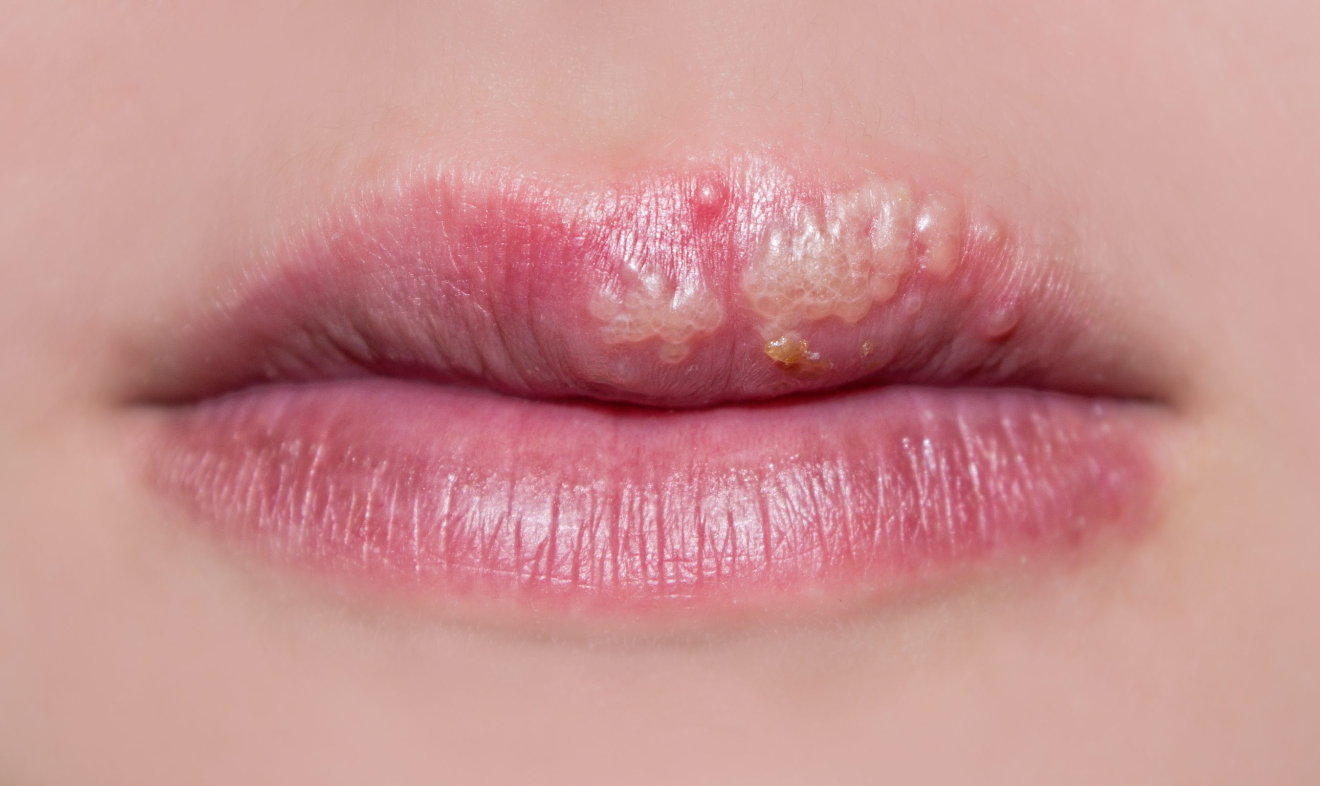 The photo shows manifestations of herpes on the lips of a girl