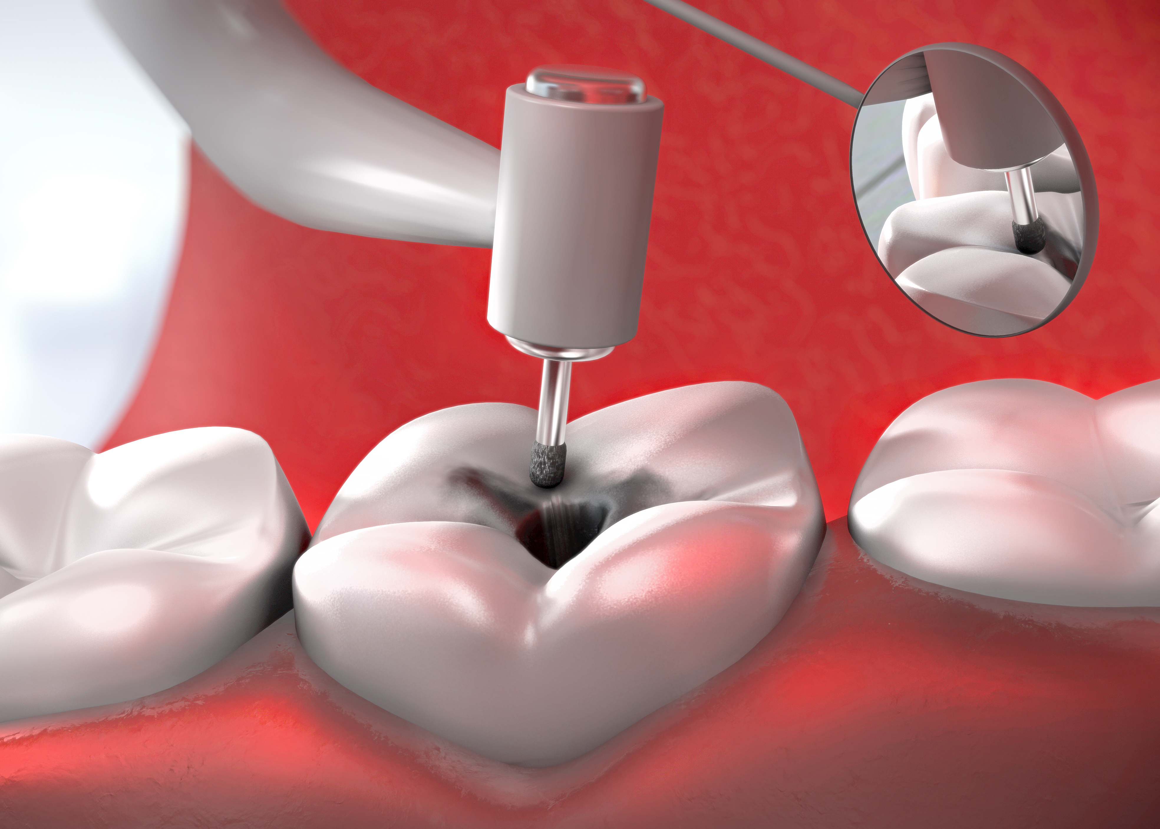 Терапевтическая стоматология пломбирование