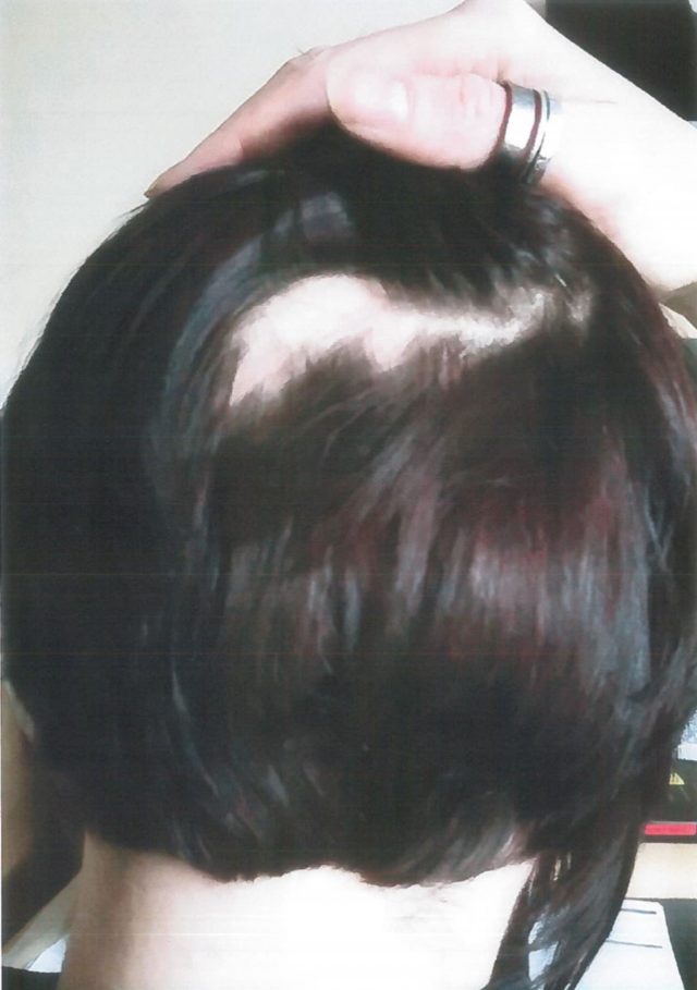 Pc Emma Agyei after she had clump of hair pulled out during a domestic disturbance (West Midlands Police/PA)