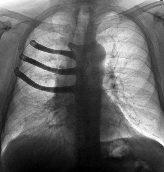 X-ray of implant fitted to Peter Maggs (ABMU Health Board/PA)