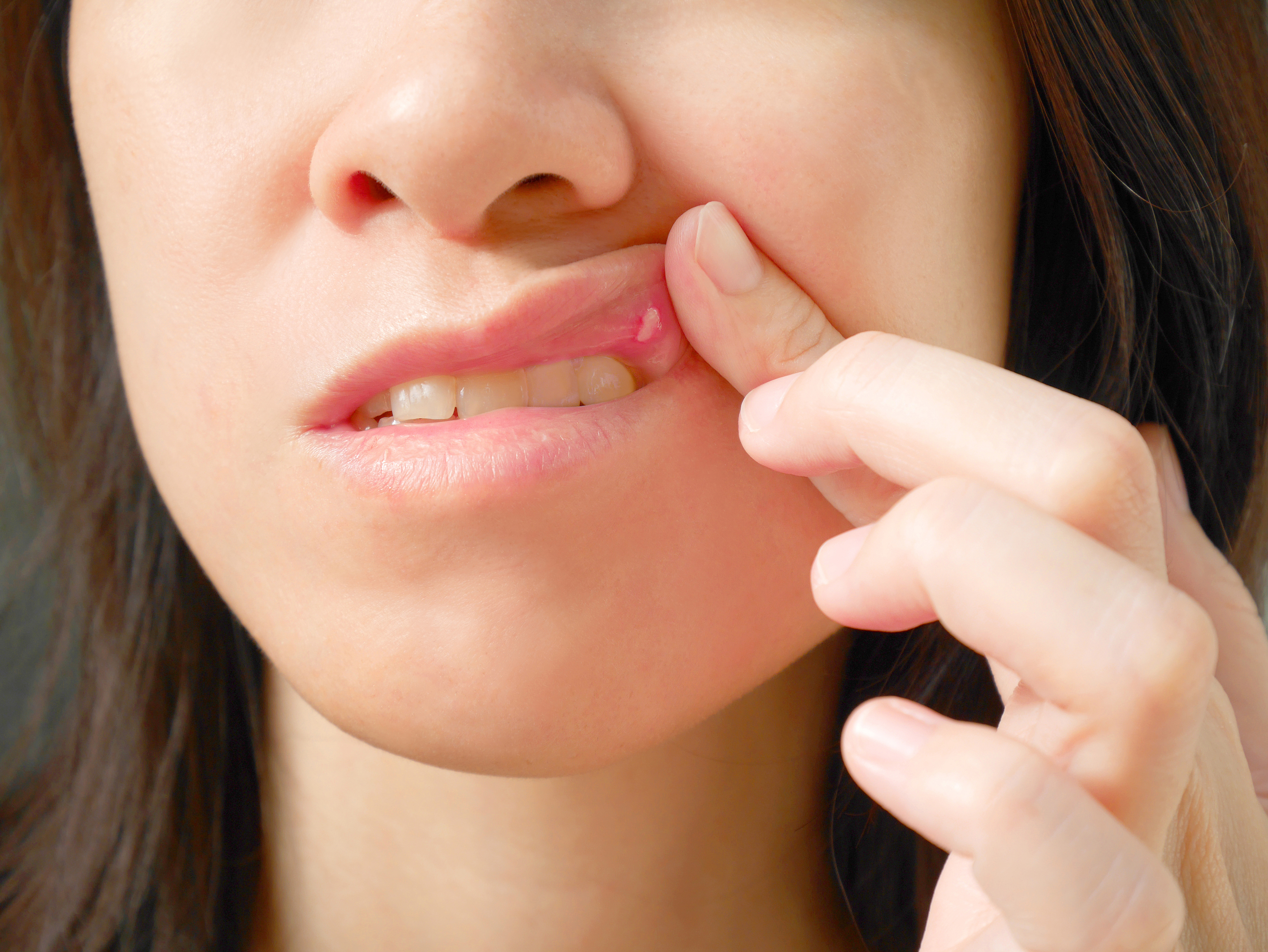 Generic photo of woman with a mouth ulcer