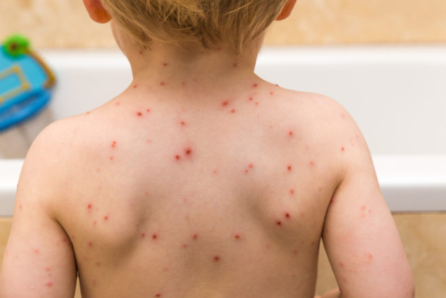 What Is My Child S Rash How To Identify 10 Rashes And Tell If They Re Serious Bt