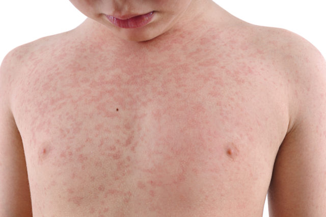 What Is My Child S Rash How To Identify 10 Rashes And Tell If They