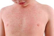 What Is My Child s Rash How To Identify 10 Rashes And Tell If They re 