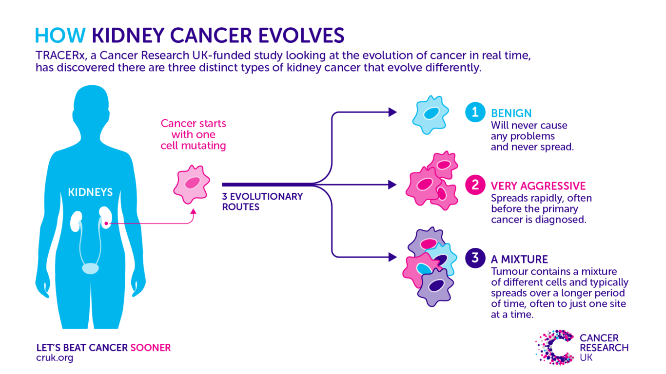 first-step-to-kidney-cancer-may-occur-in-childhood-study-finds