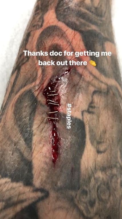 A photo of Aaron Ramsey's leg from his Instagram story