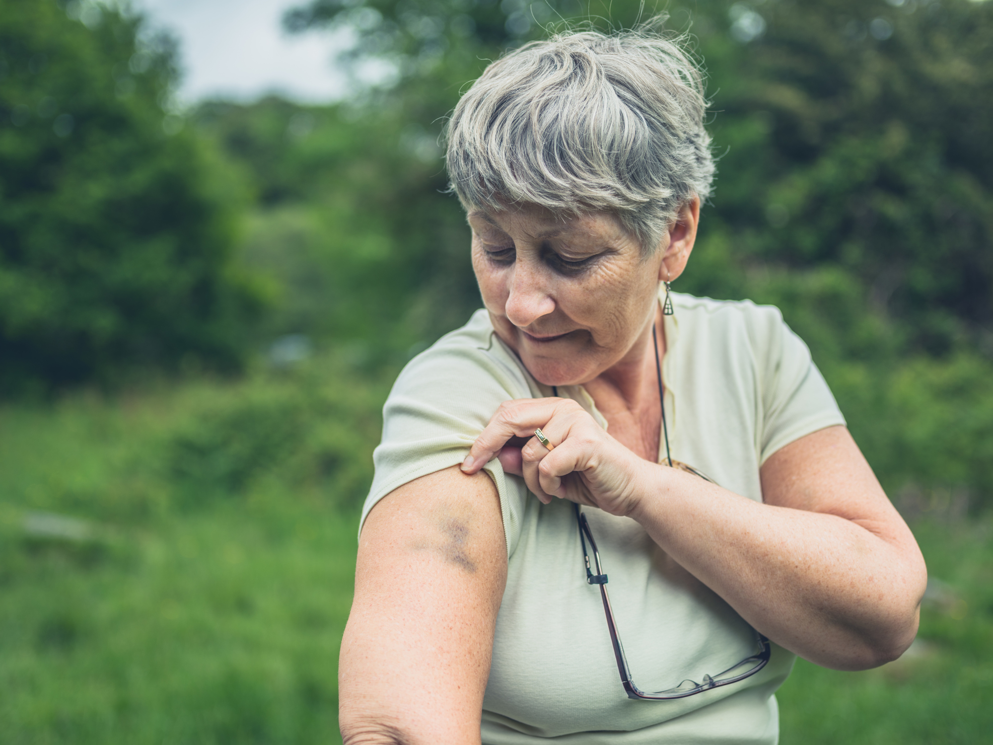 Older woman with a bruise