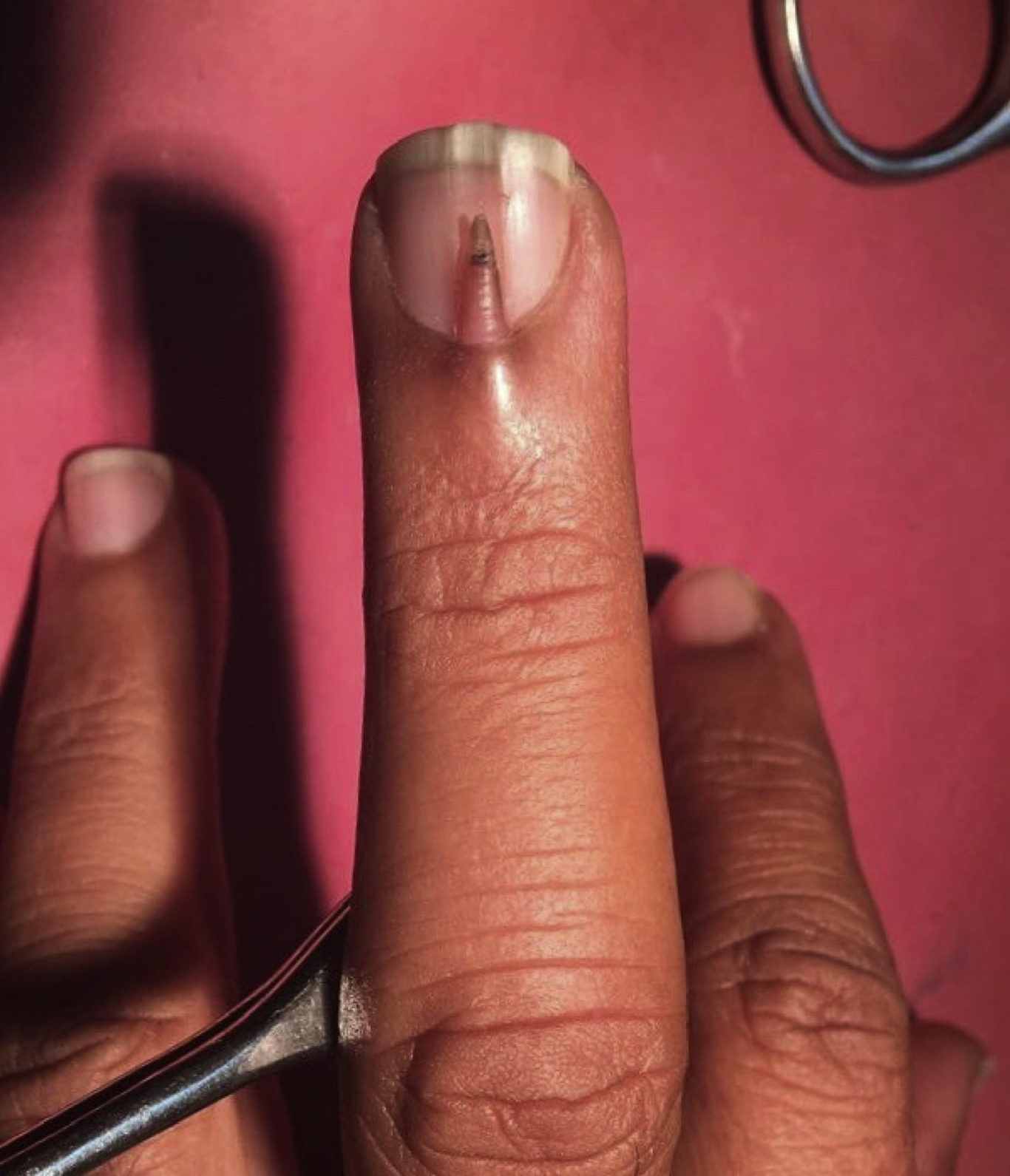 Will A Finger Nail Grow Back If Pulled Out