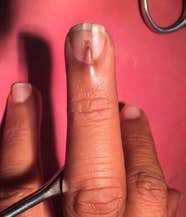 This Man Had An Extra Nail Growing Out Of His Middle Finger 