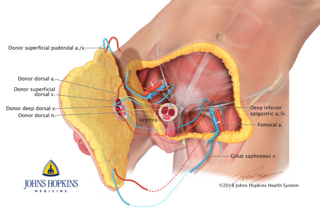 World's first penis and scrotum transplant.