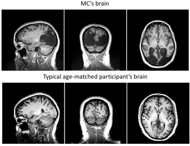 Milena Canning's brain compared with a regular person's brain of the same age.