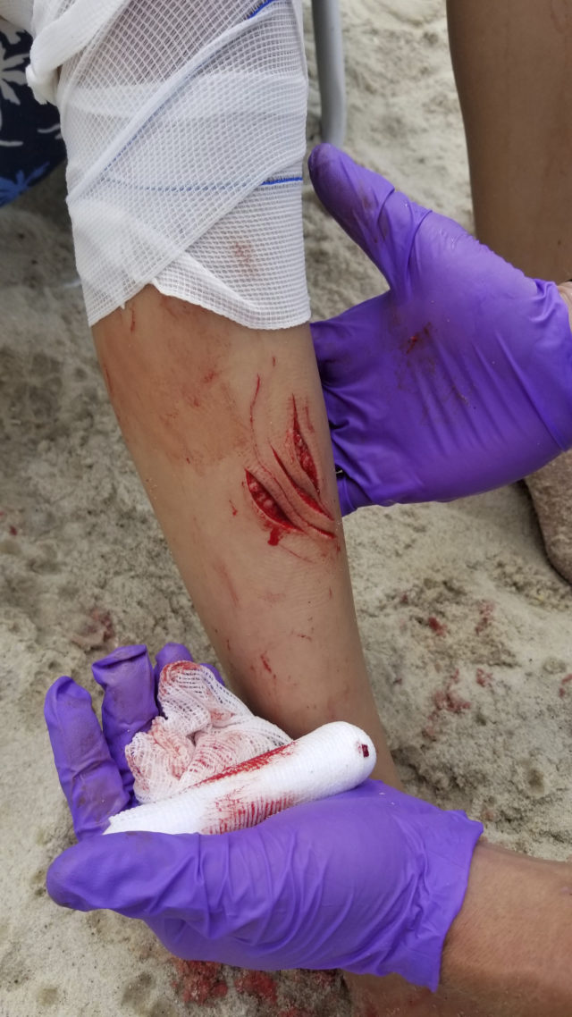 Wounds consistent with a shark attack on the leg of 12-year-old Lola Pollina