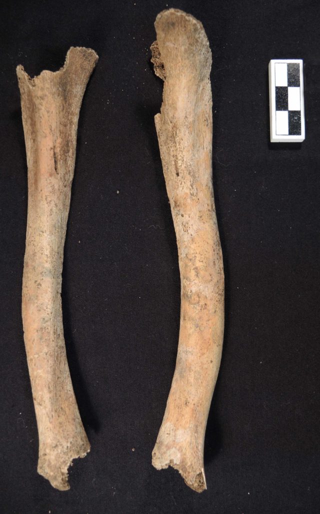 A skeleton showing evidence of rickets (Historic England/PA)