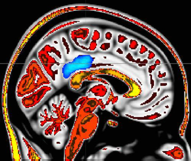 fMRI scan