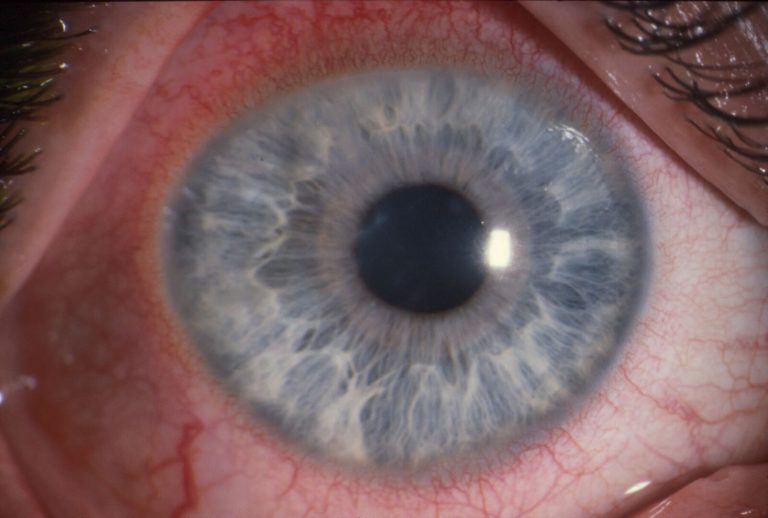 Blindnesscausing eye infection sparks contact lens warning BT