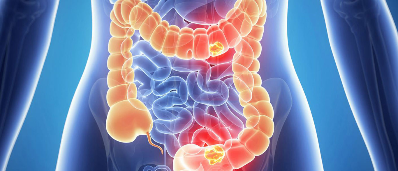 Improved Analysis Of Bowel Cancer Tumours ‘could Mean Better Outcomes