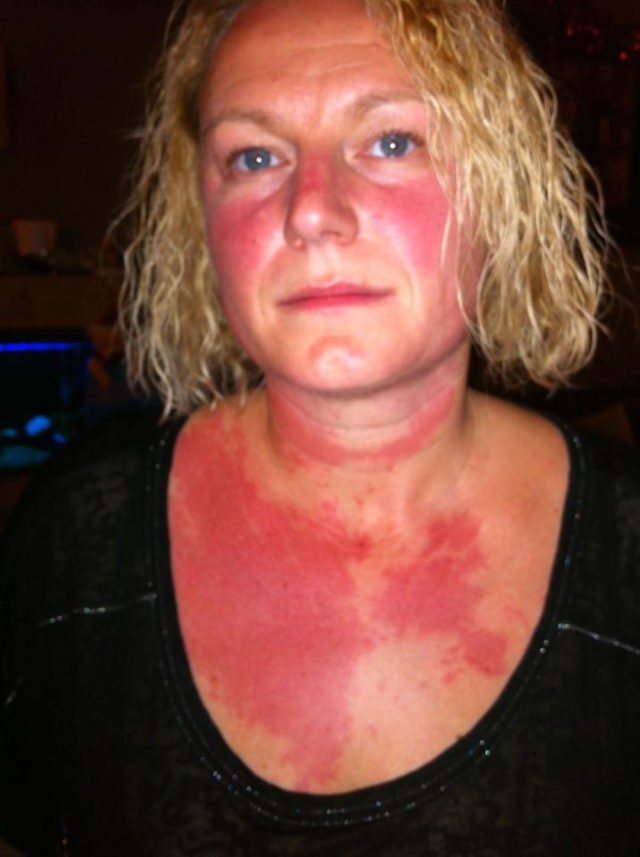 Mum Reveals How Booze Can Trigger A Burning Red Rash Which Coats Her