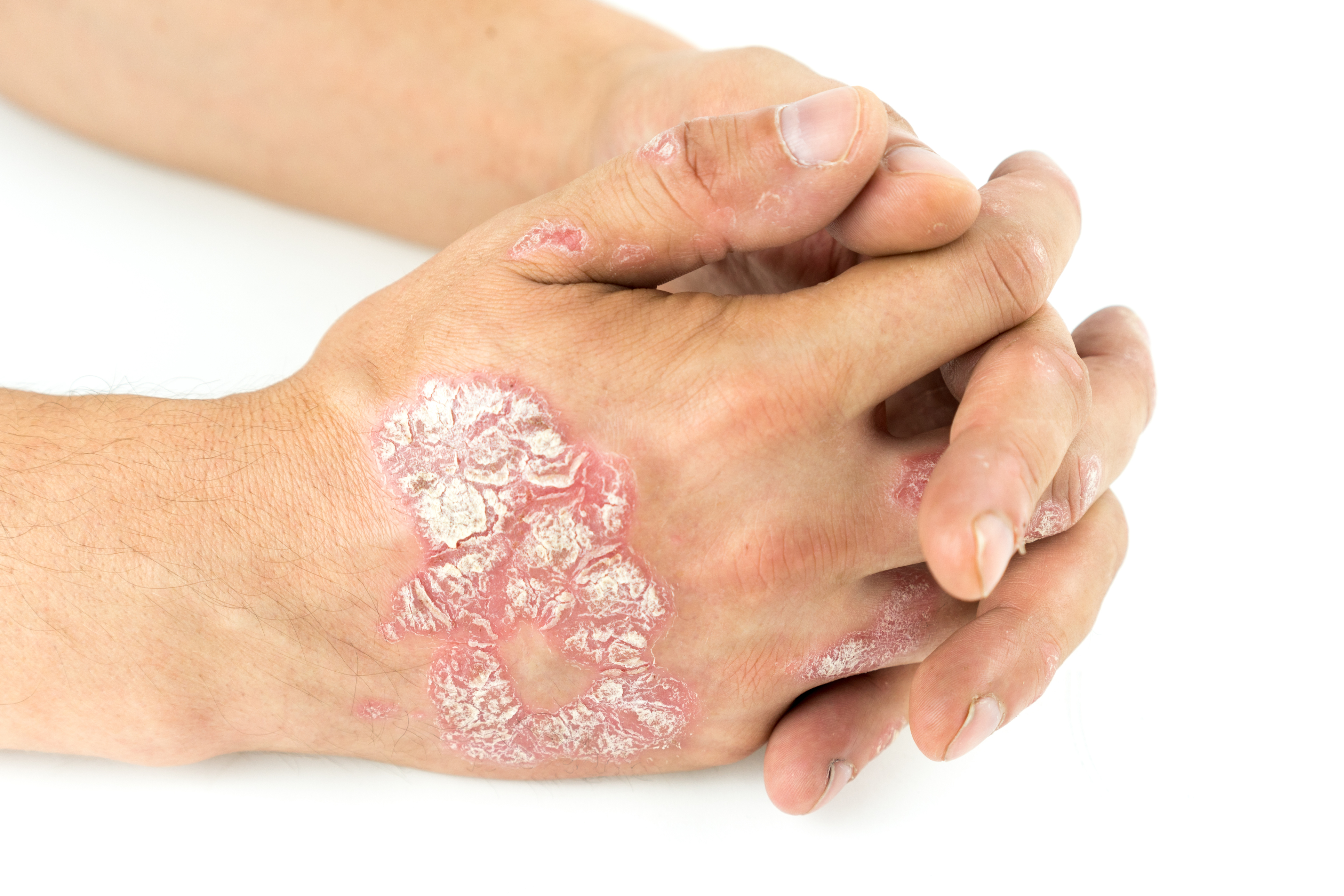 Psoriasis vulgaris on the male hands with plaque, rash and patches, isolated on white background. Autoimmune genetic disease.