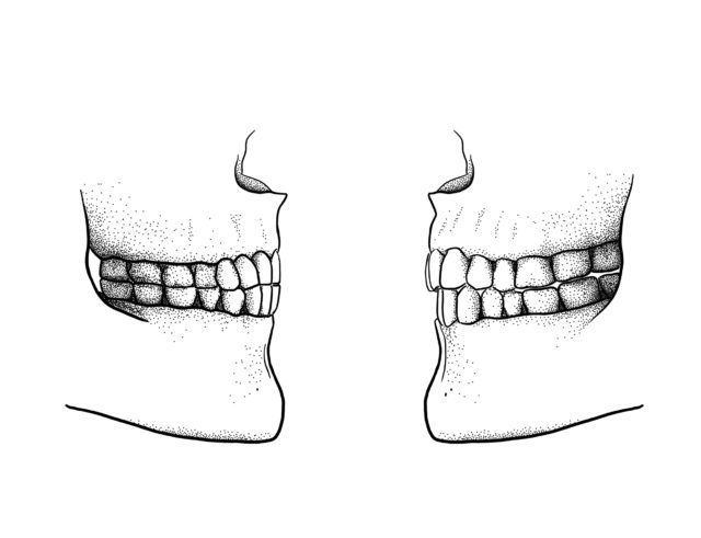 The difference between the edge-to-edge bite (left) and a modern overbite (Scott Moisik/ PA)