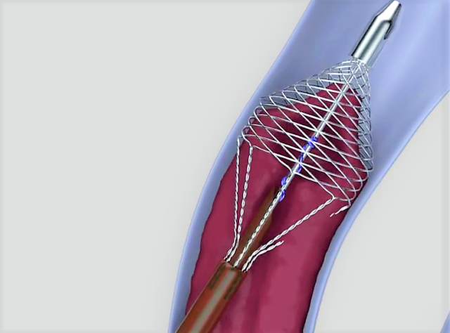 The device is inserted into vein and deploys a basket which touches each wall (Vetex Medical/ PA)