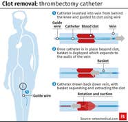 UK Patient First To Be Treated With Clot removing Device Express Star