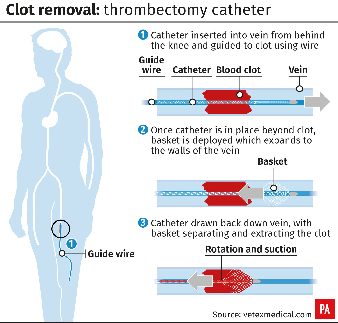 Clot removal: thrombectomy catheter