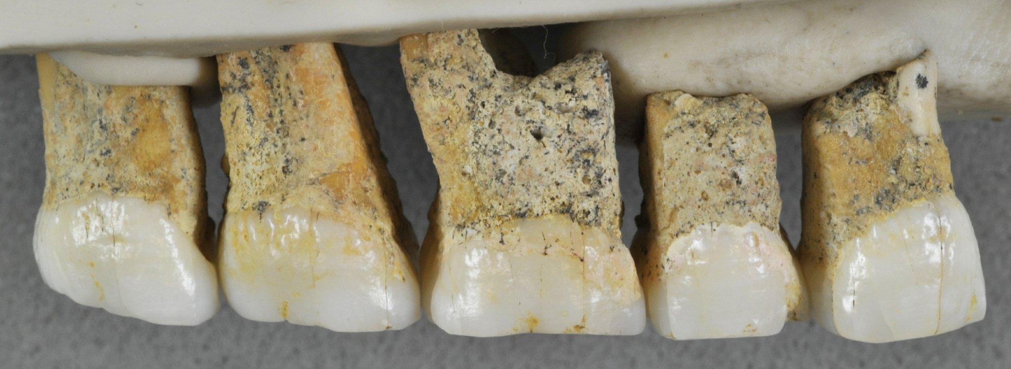 The right upper teeth of the individual CCH6 of the newly discovered species Homo luzonensis