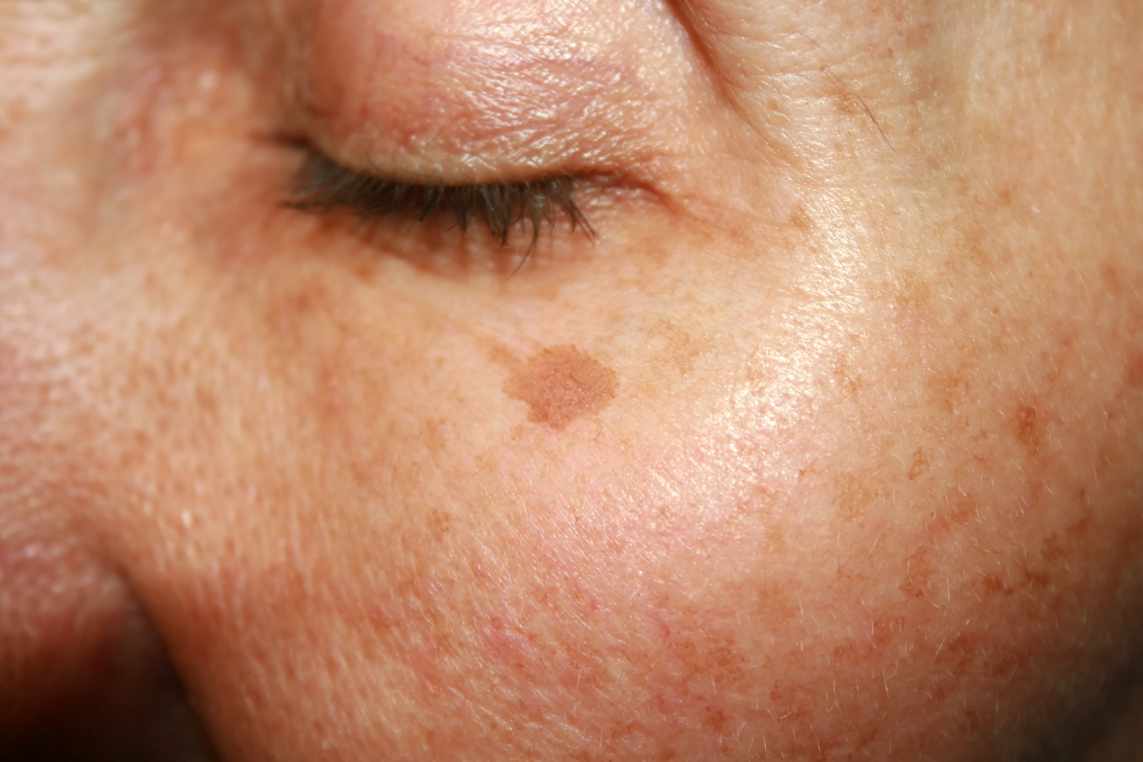 Brown spots under the eye. Pigmentation on the face