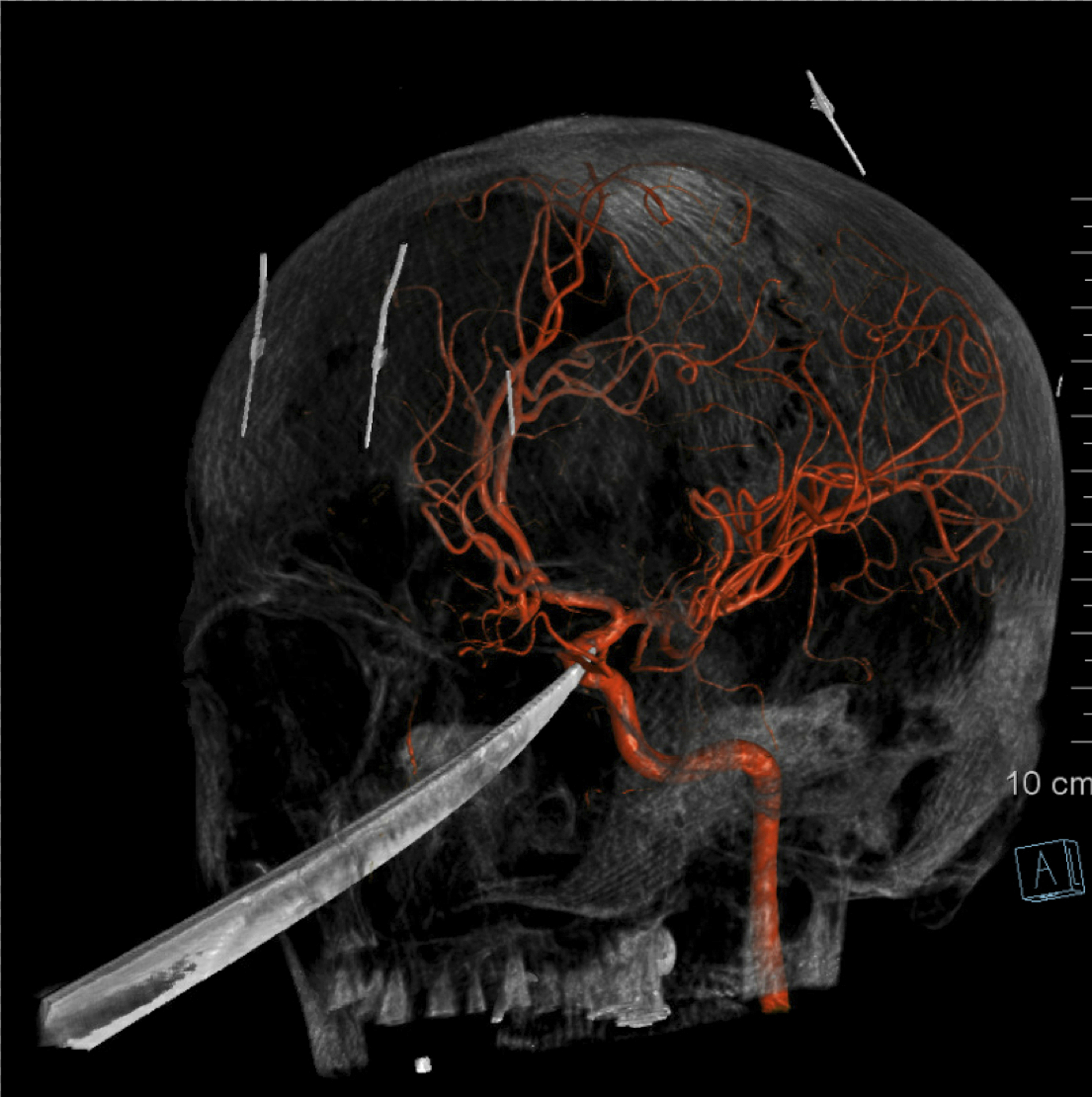 3D computer graphic model made from X-Ray imagery by The University of Kansas Health System shows how a tip of the knife stopped right on and was pressed against the carotid artery
