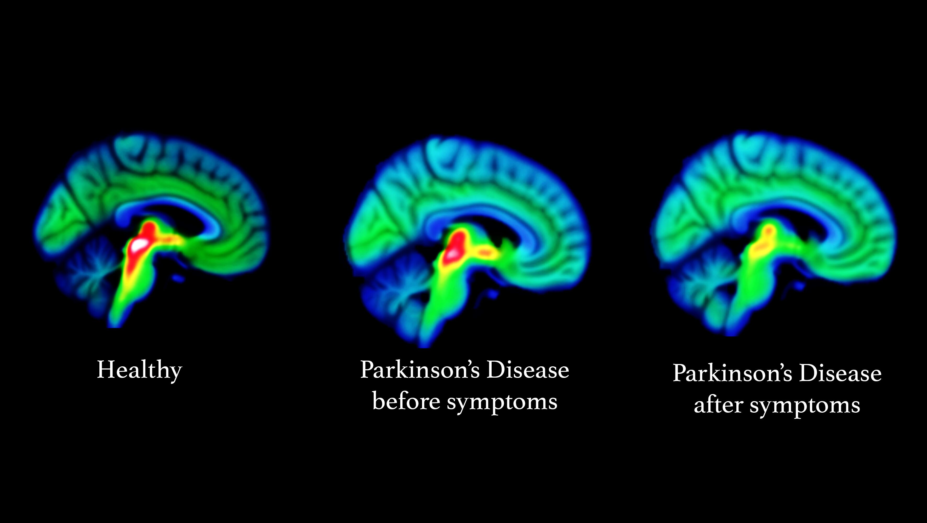 The red and yellow areas shown in brain imaging scans show that serotonin function reduces before movement symptoms develop (KCL/ PA)